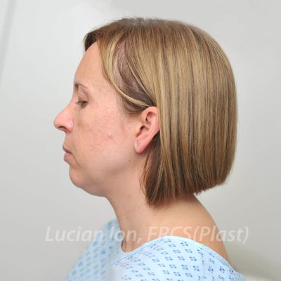 Before short scar facelift, case 2, profile view