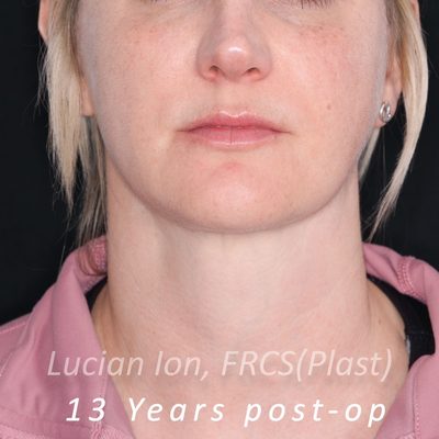 After anterior neck lift, case 1, front view