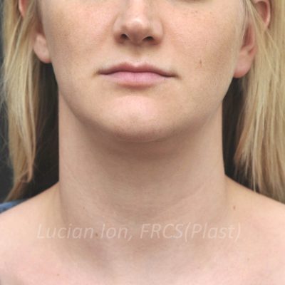 Before anterior neck lift, case 1, front view