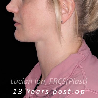 After anterior neck lift, case 1, profile view