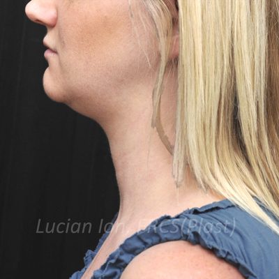 Before anterior neck lift, case 1, profile view