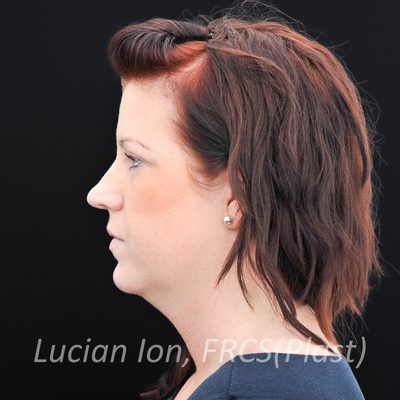 Before anterior neck lift, case 2, profile view