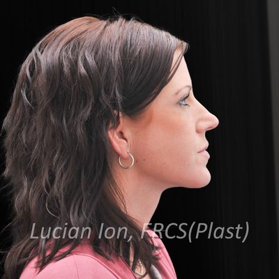 After anterior neck lift, case 2, profile view