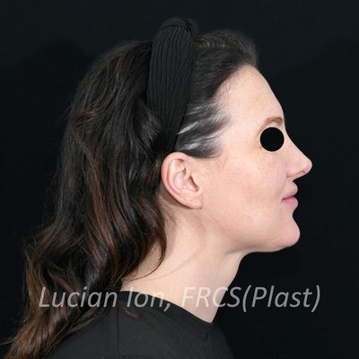 After anterior neck lift, case 3, profile view