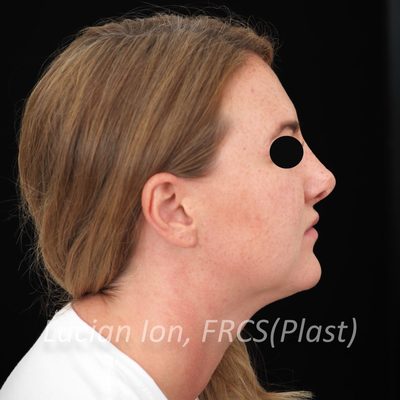 Before anterior neck lift, case 3, profile view