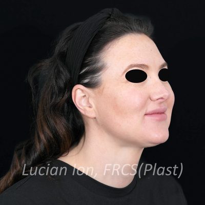After anterior neck lift, case 3, oblique view