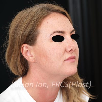 Before anterior neck lift, case 3, oblique view