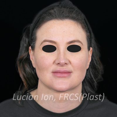 After anterior neck lift, case 3, front view