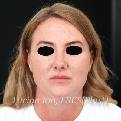 Before anterior neck lift, case 3, front view