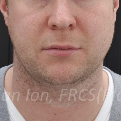 Before anterior neck lift, case 4, view 1 view