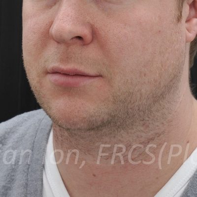 Before anterior neck lift, case 4, view 2 view