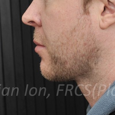 After anterior neck lift, case 4, view 3 view