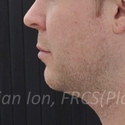 Before anterior neck lift, case 4, view 3 view
