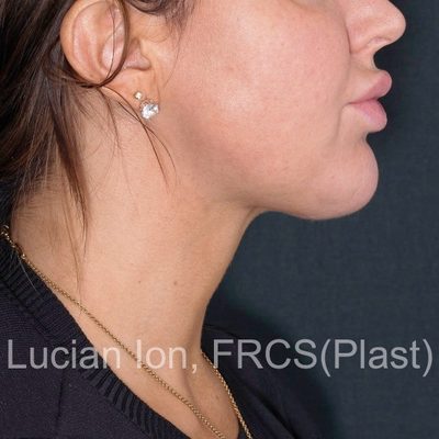After anterior neck lift, case 5, profile view