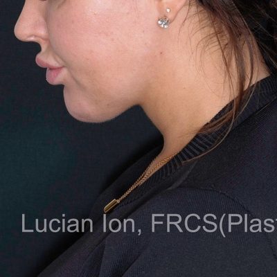 After anterior neck lift, case 5, profile, neck flexed view
