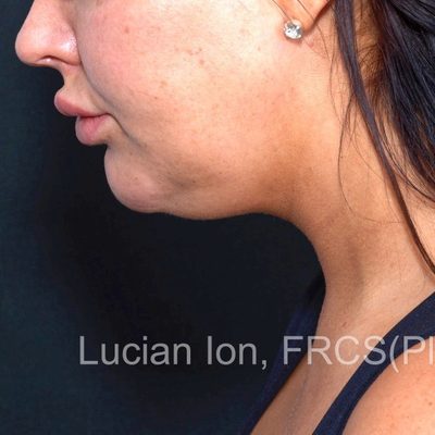 Before anterior neck lift, case 5, profile, neck flexed view