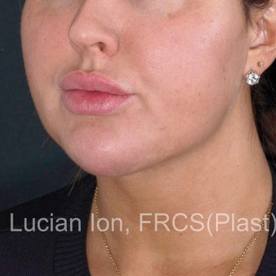 After anterior neck lift, case 5, oblique view
