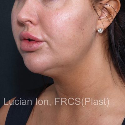 Before anterior neck lift, case 5, oblique view