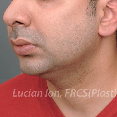Before anterior neck lift, case 6, oblique view