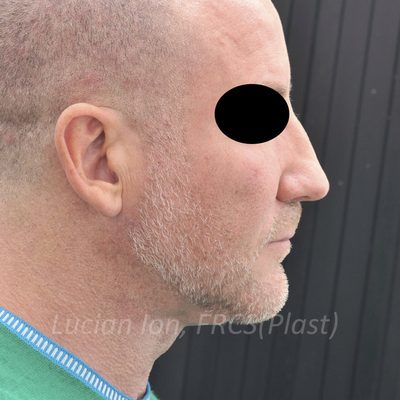 After anterior neck lift, case 7, view 2 view