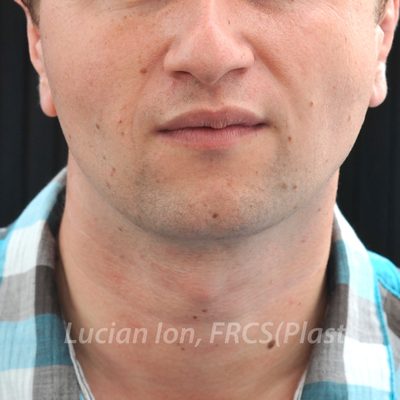 After buccal fat reduction, case 1, front view