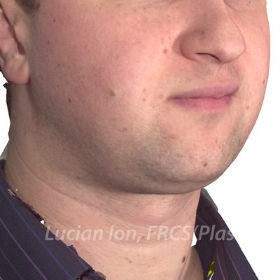 Before buccal fat reduction, case 1, oblique view