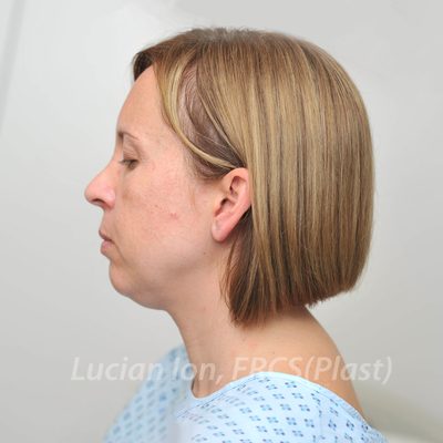 Before chin enhancement, case 1, profile view
