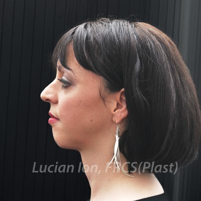 Before chin enhancement, case 2, profile view
