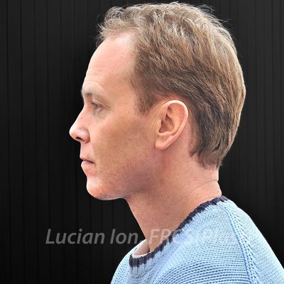 After chin enhancement, case 3, profile view