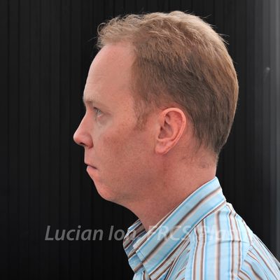 Before chin enhancement, case 3, profile view