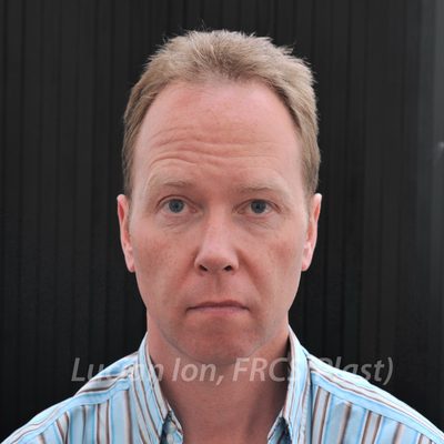 Before chin enhancement, case 3, front view