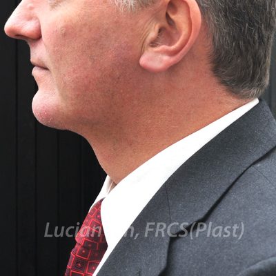 After chin enhancement, case 4, profile view