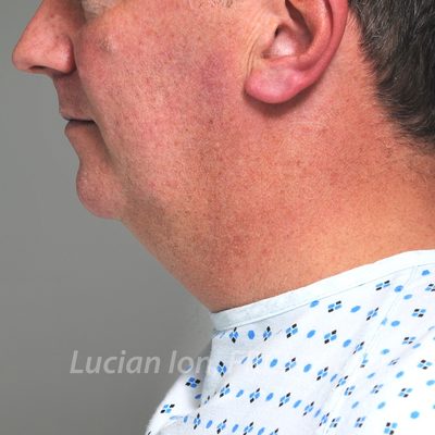 Before chin enhancement, case 4, profile view