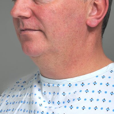 Before chin enhancement, case 4, oblique view
