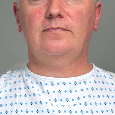 Before chin enhancement, case 4, front view