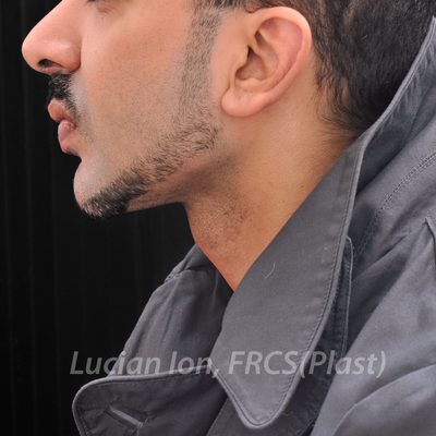 After chin enhancement, case 5, profile view