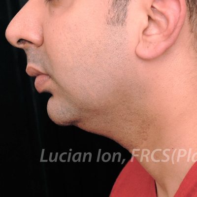 Before chin enhancement, case 5, profile view