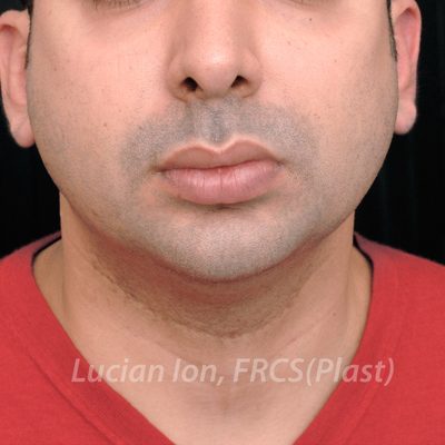 Before chin enhancement, case 5, front view