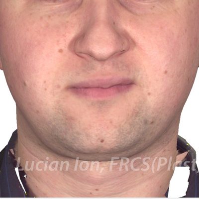 Before facial and neck liposuction, case 1, front view