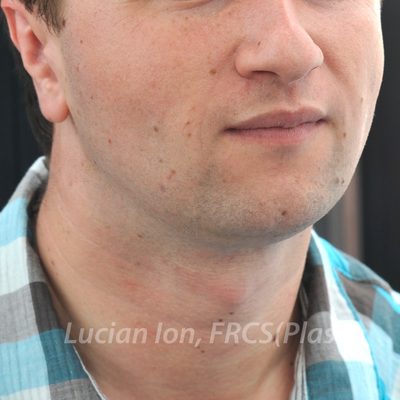 After facial and neck liposuction, case 1, oblique view