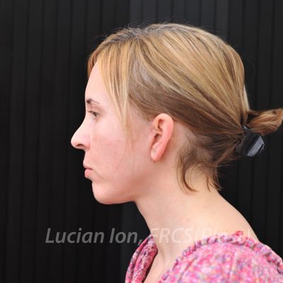 After fat transfer, case 1, profile view