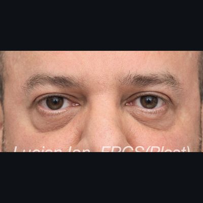 Before fat transfer, case 2, view 1 view