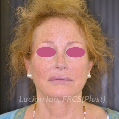 After fat transfer, case 3, front view