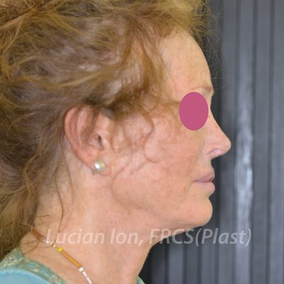 After fat transfer, case 3, profile view