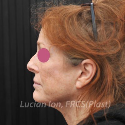 Before fat transfer, case 3, profile view