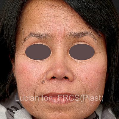 After augmentation rhinoplasty, case 1, front view