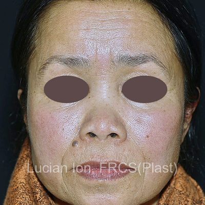 Before augmentation rhinoplasty, case 1, front view