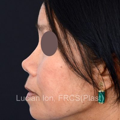 After augmentation rhinoplasty, case 1, profile view