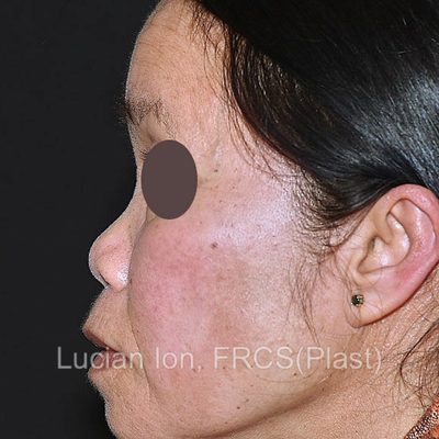 Before augmentation rhinoplasty, case 1, profile view