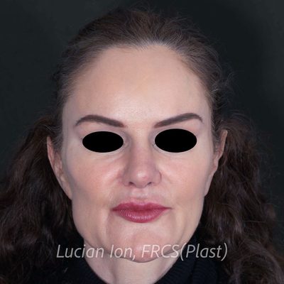 After augmentation rhinoplasty, case 2, front view